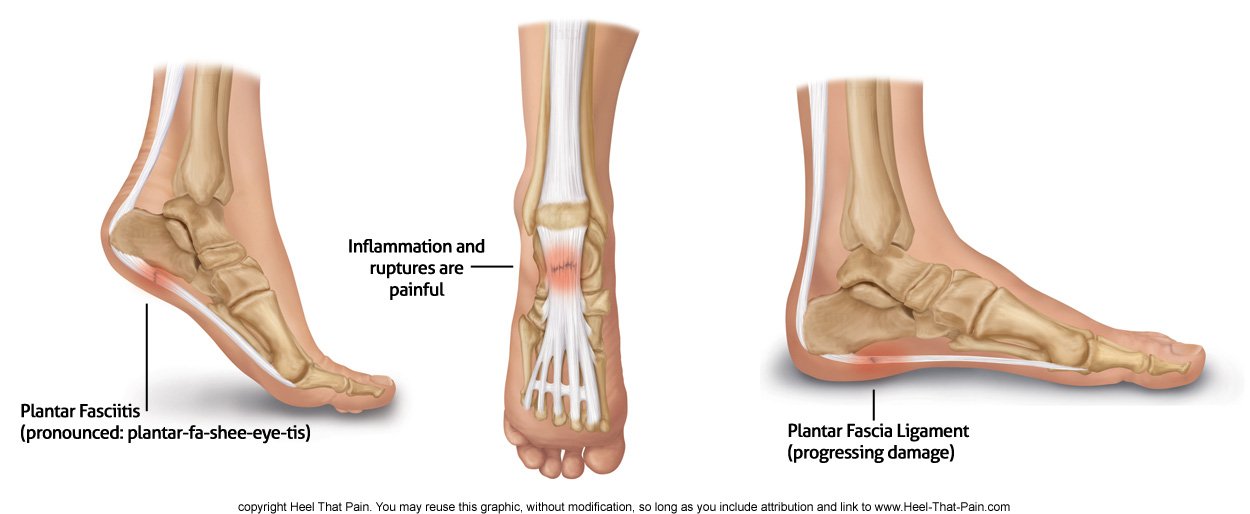 PLANTAR FASCIITIS